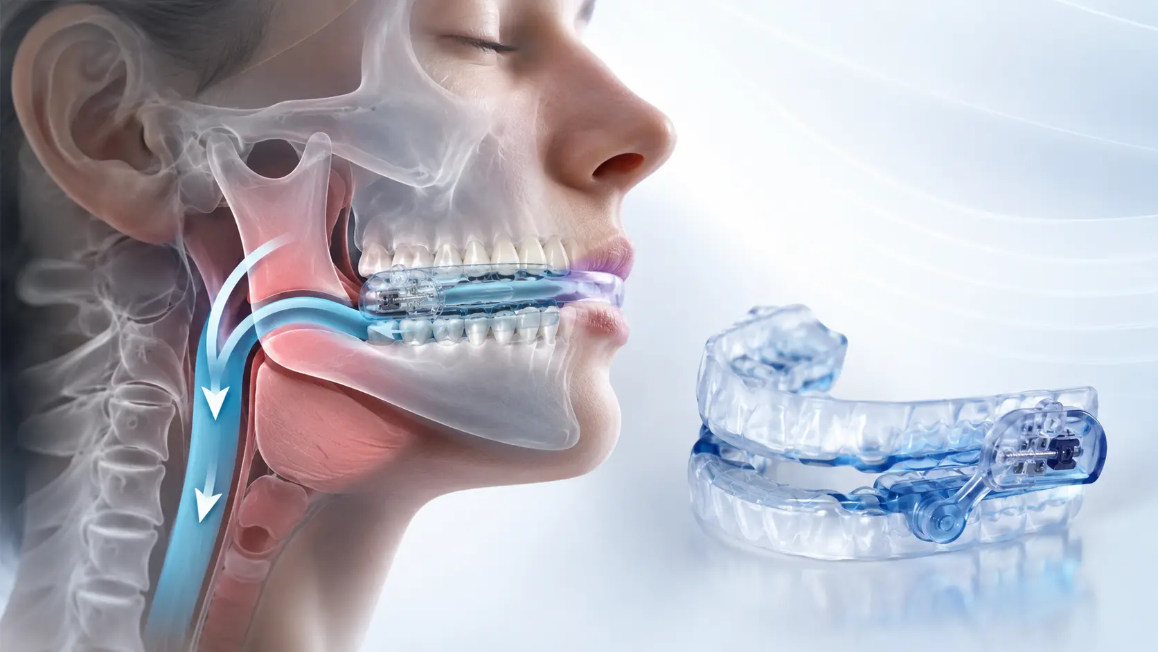 custom snoring mouth guard dentist
